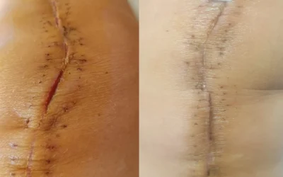Tratamiento de cicatrices complejas en prótesis de rodilla