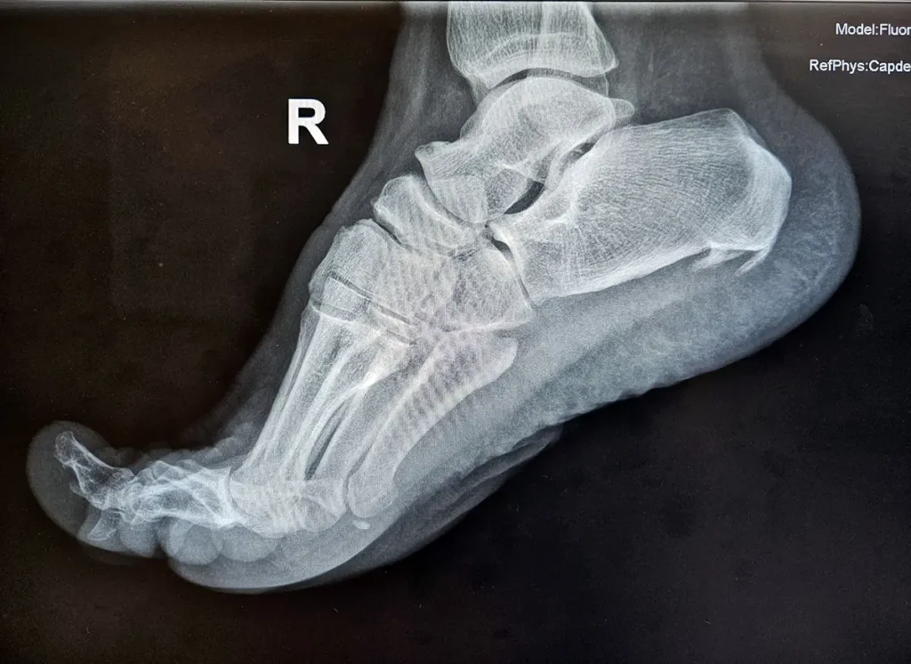 Doble espolón calcáneo con fascitis plantar