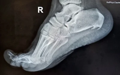 Reabsorción de espolón calcáneo y fascitis plantar