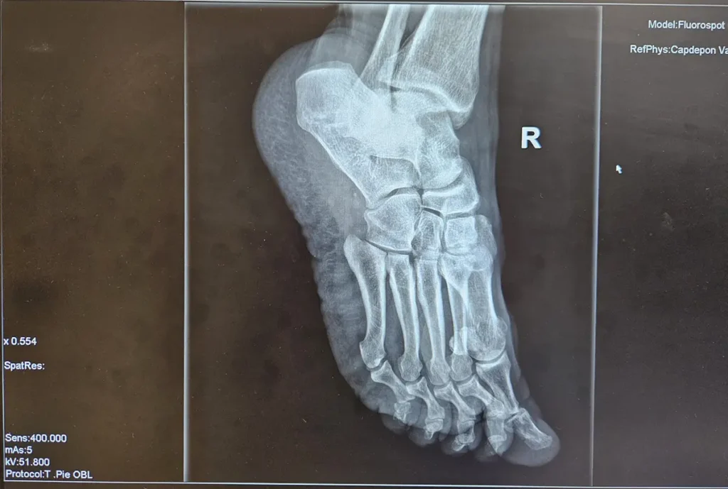 Resultado tratamiento doble espolón calcáneo con fascitis plantar