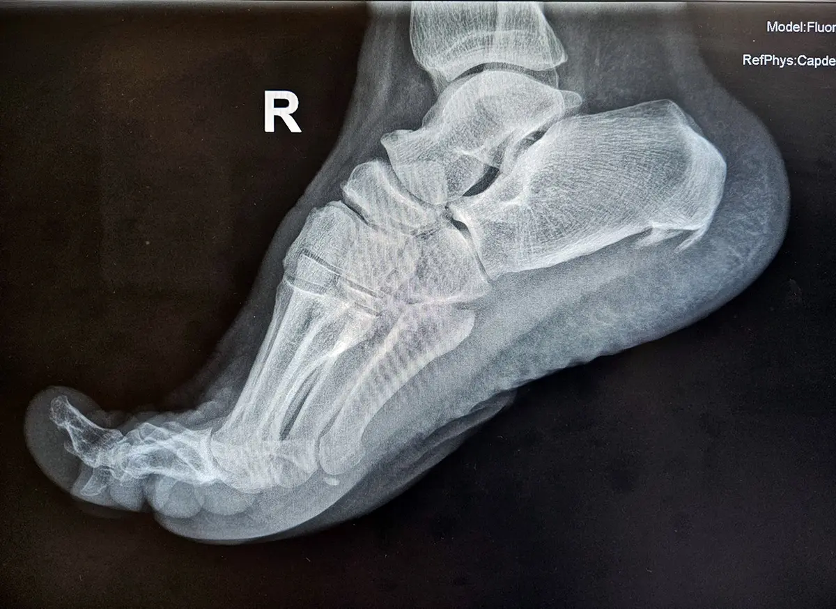 Doble espolón calcáneo con fascitis plantar Doble espolón calcáneo con fascitis plantar